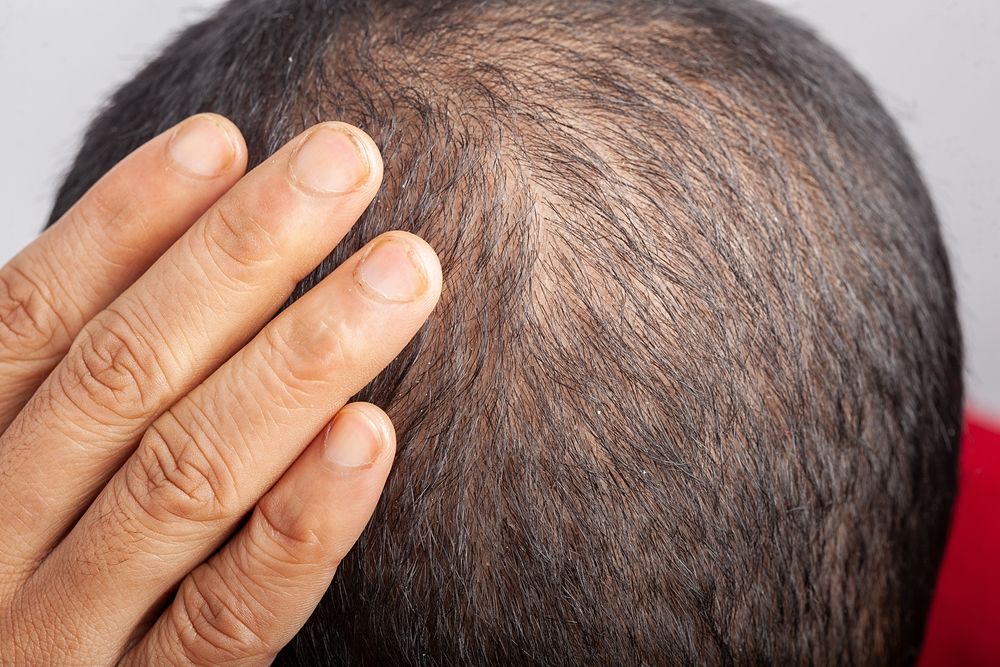 Alopecia seborreica: qué es, por qué se produce y cómo tratarla | Farma Segura
