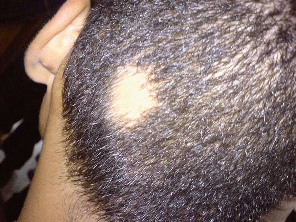 Blog 4 mejores tratamientos para la alopecia areata