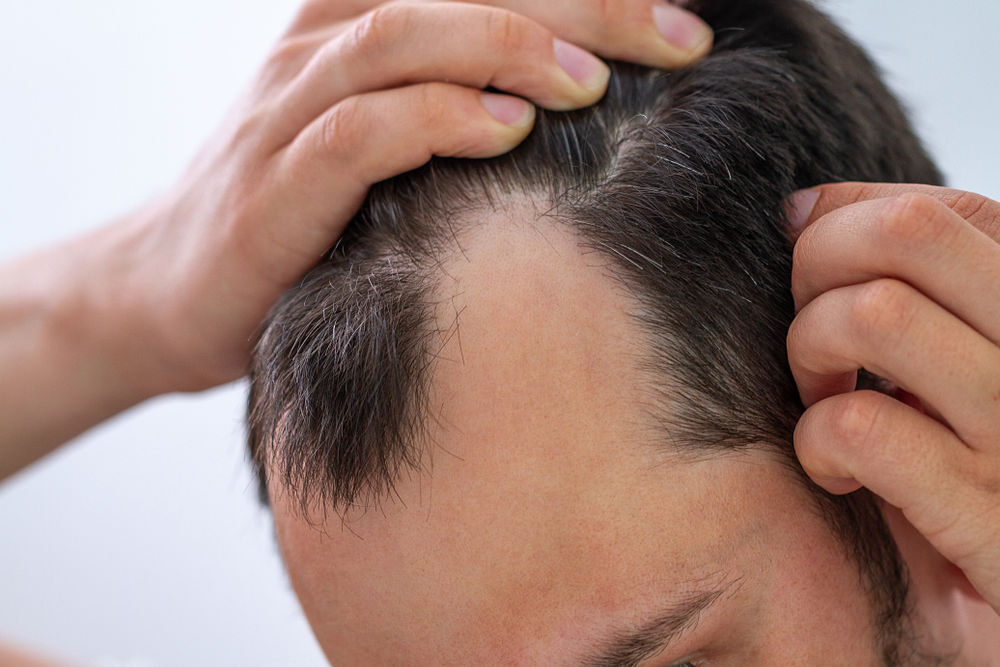 Qué es la alopecia nerviosa y cuál es el mejor tratamiento