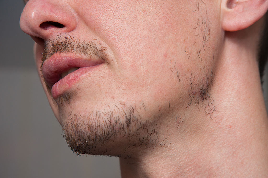 - ¿Se cae la barba después de usar minoxidil?